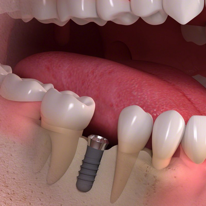 Зубной имплантат
